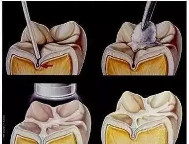 窝沟封闭示意图